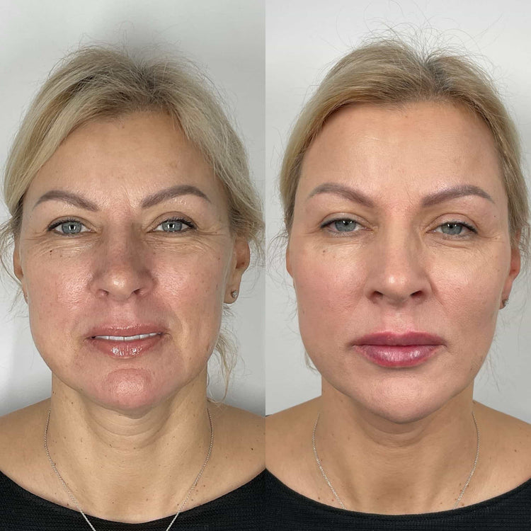 Skin Booster For Dark Circles in Horsell, Surrey
