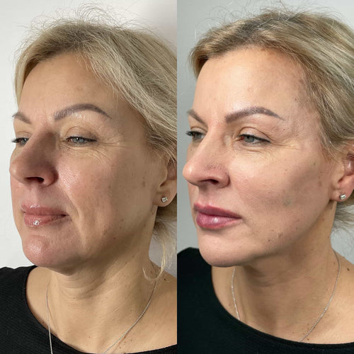 Lip Filler Swelling When Sick