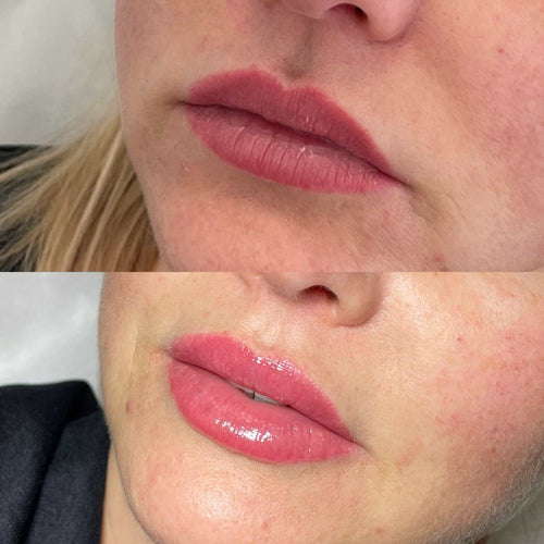 Do Cheek Fillers Sag Over Time?