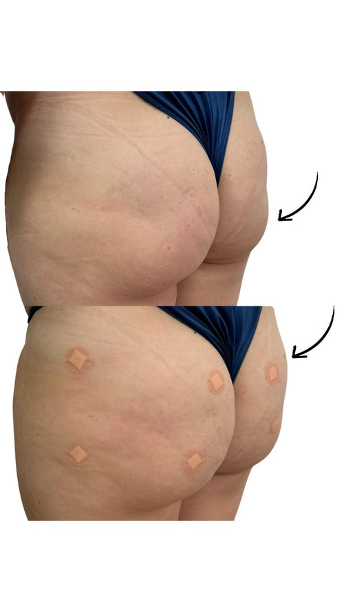 Is Non-Surgical Bum Lift (BBL) with PLLA Safe for Everyone?