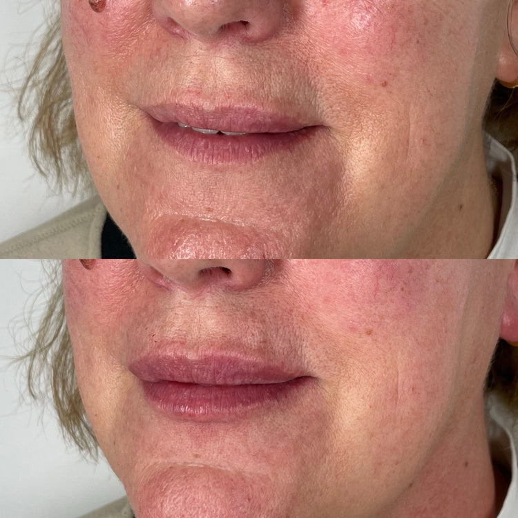 Dermal Fillers and Facial Symmetry: Balancing Features for a Harmonious Look